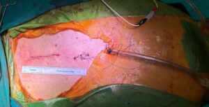 αντιμετώπιση ανευρίσματος αορτής