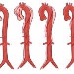 Πότε χειρουργείται η αορτική βαλβίδα;