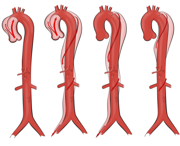 Πότε χειρουργείται η αορτική βαλβίδα;